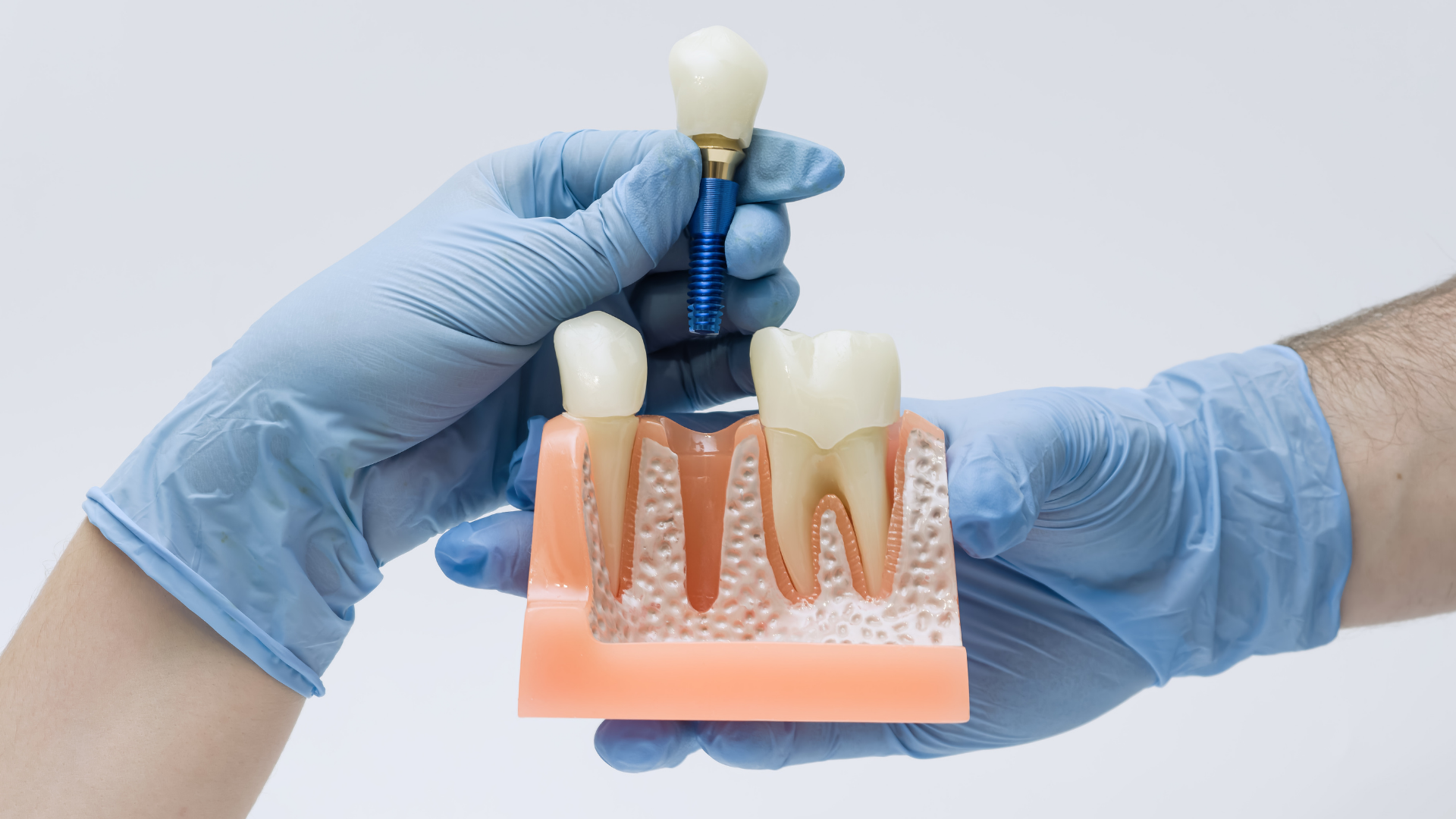 Blog Implantes