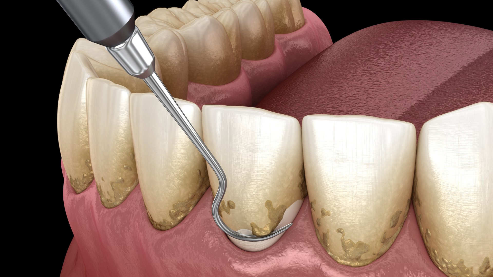Periodoncia